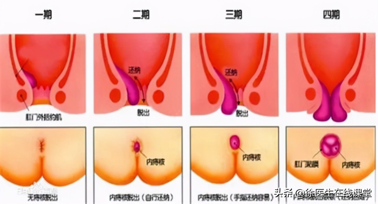 肛门边有个肉球不痛不痒怎么治疗,肛门外有个肉球不痛不痒怎么治疗