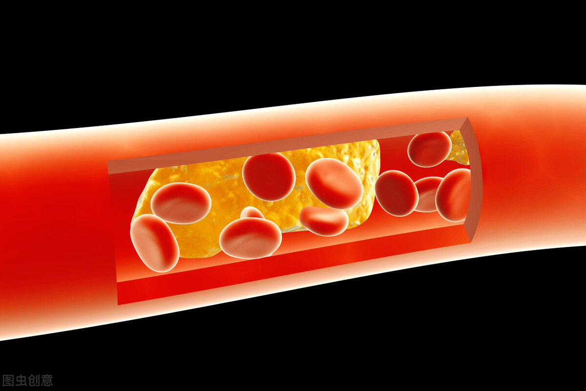 身体出现这四种症状提示血管狭窄,身体出现6种症状说明血管硬了