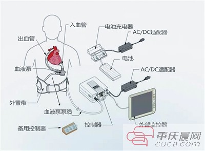 永仁心国内首款人工心脏获批上市,重庆永仁心是上市公司吗