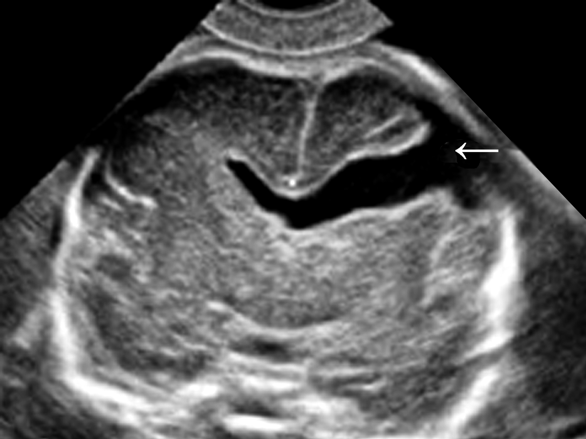 明明白白做b超,超声提示宫内单胎头位