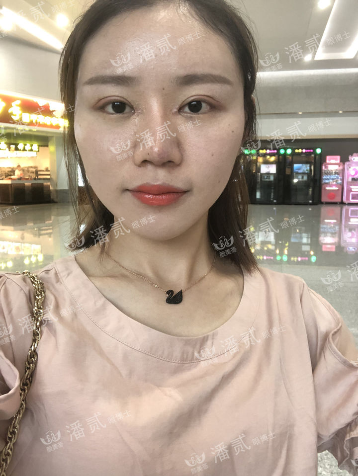 开眼角过大图片,开眼角过大修复效果图