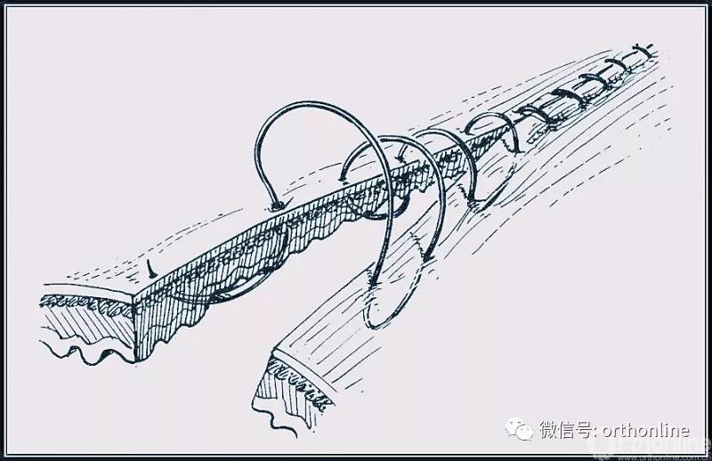 十种外科基本缝合方式详解,手术切口缝合有哪几种