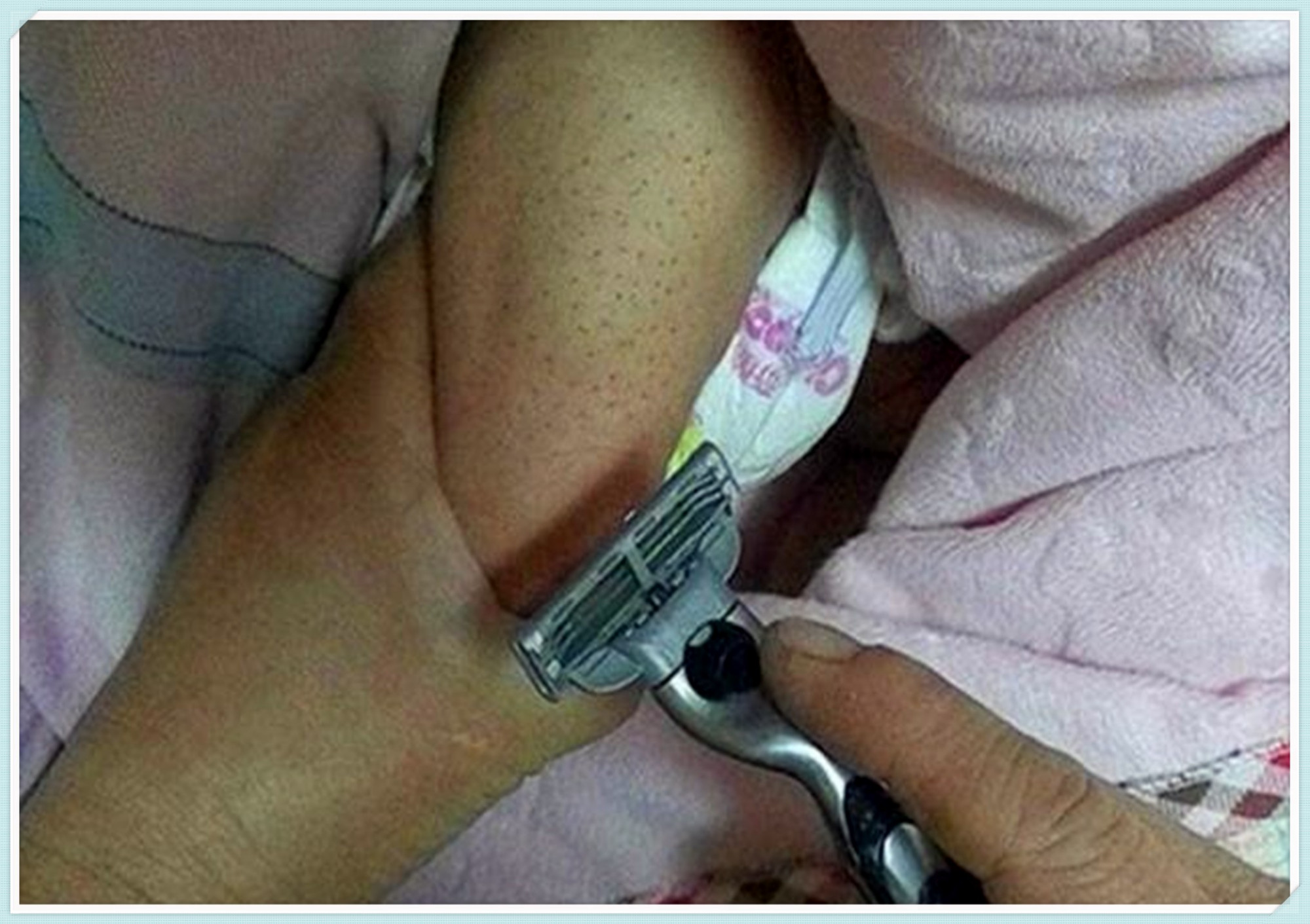 宝宝身上长有小黑刺怎么办,新生儿背部长黑刺怎么治