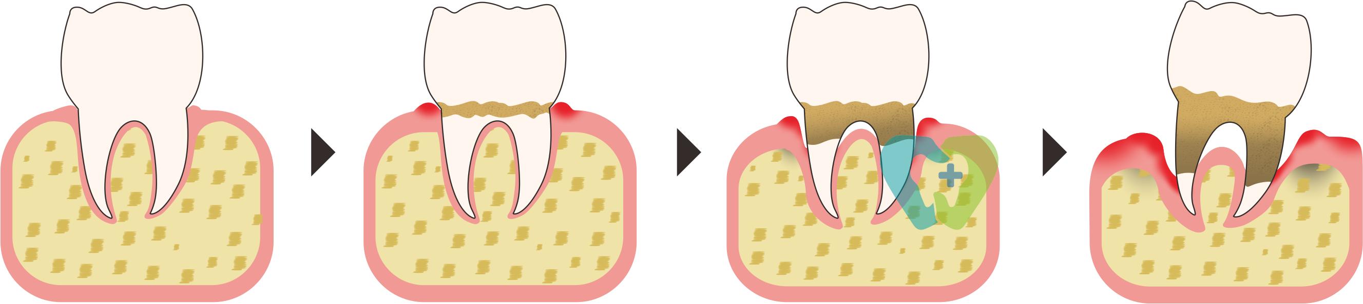 梦里牙齿松动自己拔掉,儿童牙齿松动怎么拔掉