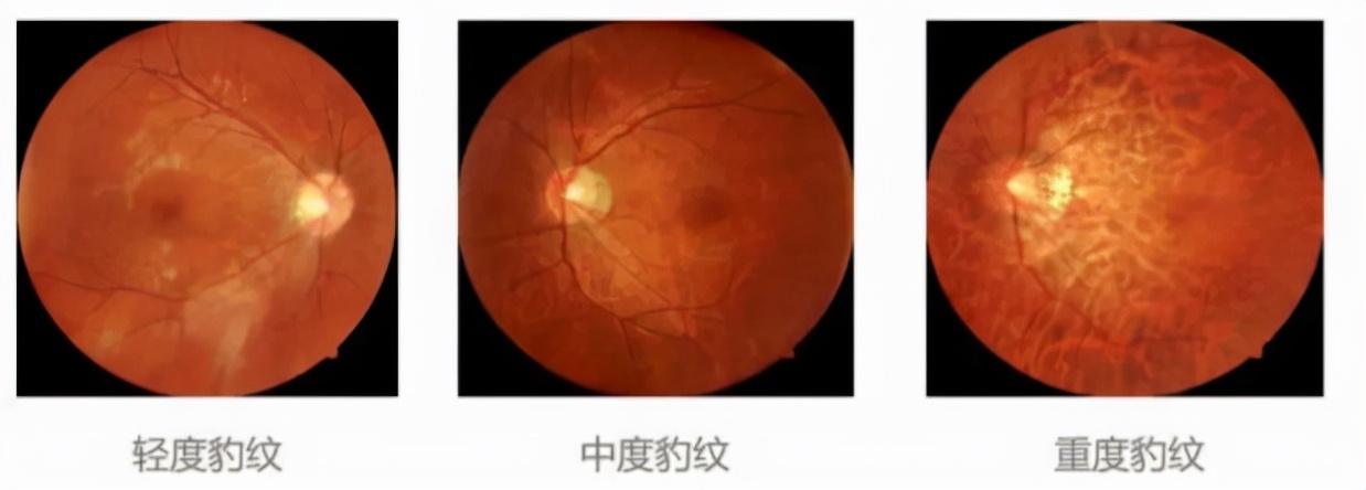 十三岁高度近视能做巩膜加固术吗,后巩膜加固术提高视力