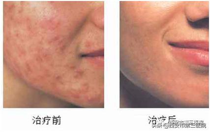 红蓝光治疗仪能治什么病,红蓝光治疗仪治什么病