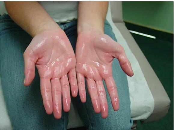 多汗症是怎么回事？如何保健？