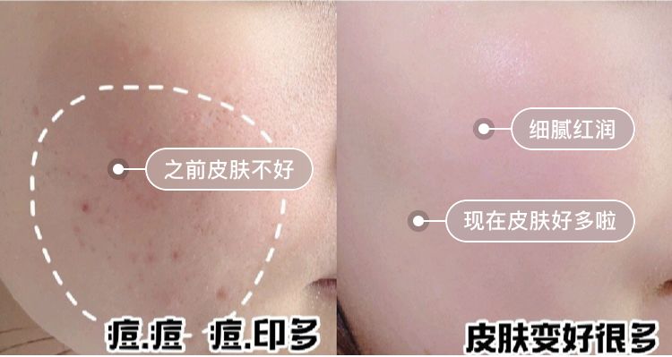 脸油痘痘多黑头用什么简单洗干净,清理黑头痘痘的最简单方法