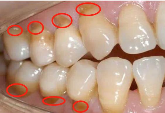 横着刷牙牙齿磨损能补吗,横向刷牙牙根磨损严重怎么修复