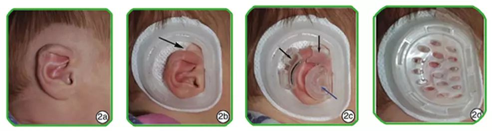 出生宝宝耳朵耳廓畸形判断,新生婴儿耳廓畸形圆耳