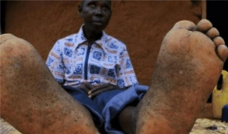 非洲有一种“寄生虫”,能钻到人脚底,小伙脚底被钻出很多个洞