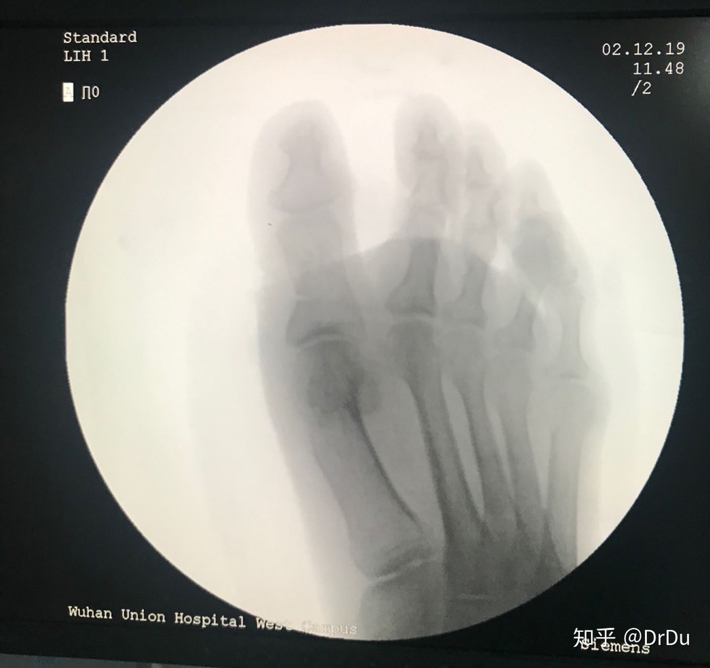 拇外翻微创手术的全过程,医生自己给自己做拇外翻手术