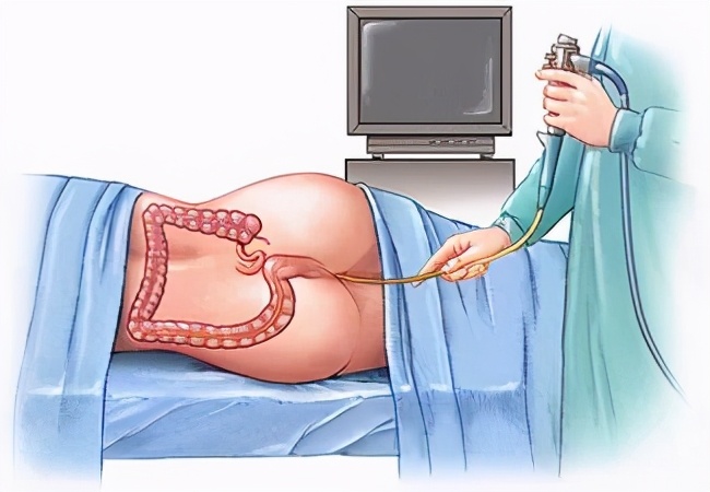 胃镜肠镜检查前的准备,做肠镜检查前做什么准备