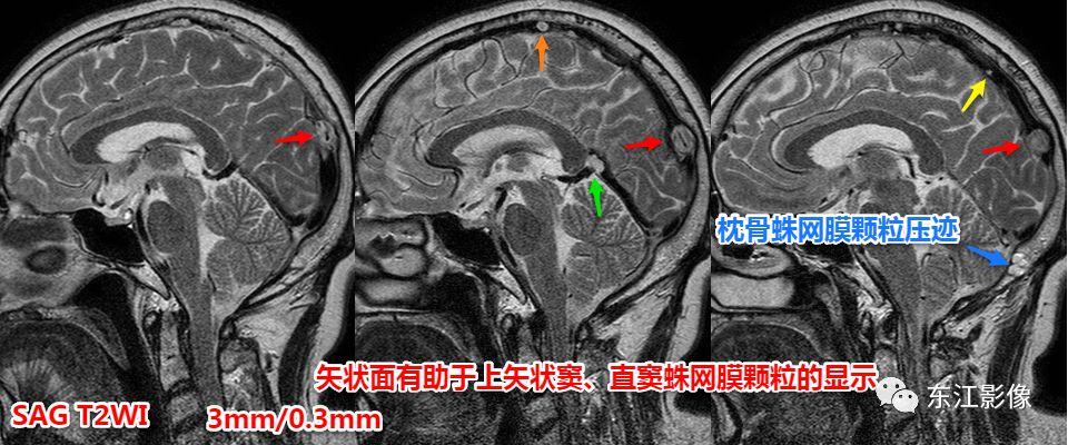 头颅mri扫描影像哪里找,头颅影像mra详细解说