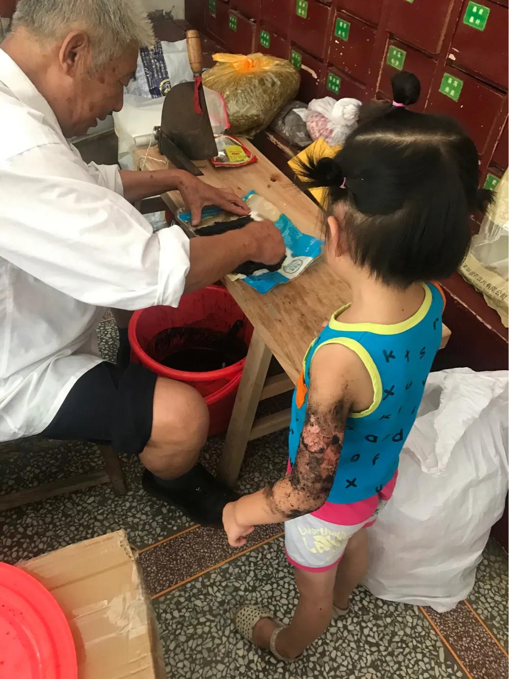 当女儿被严重烫伤疼痛难忍,幼儿园女孩被烫伤治疗过程