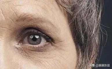 怎么改善熬夜的黑眼圈和眼角细纹,干眼症导致的黑眼圈怎样去除