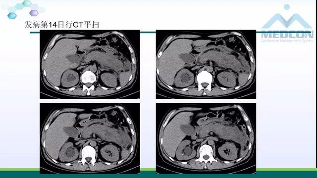 急性胰腺炎的护理措施,急性胰腺炎影像与临床