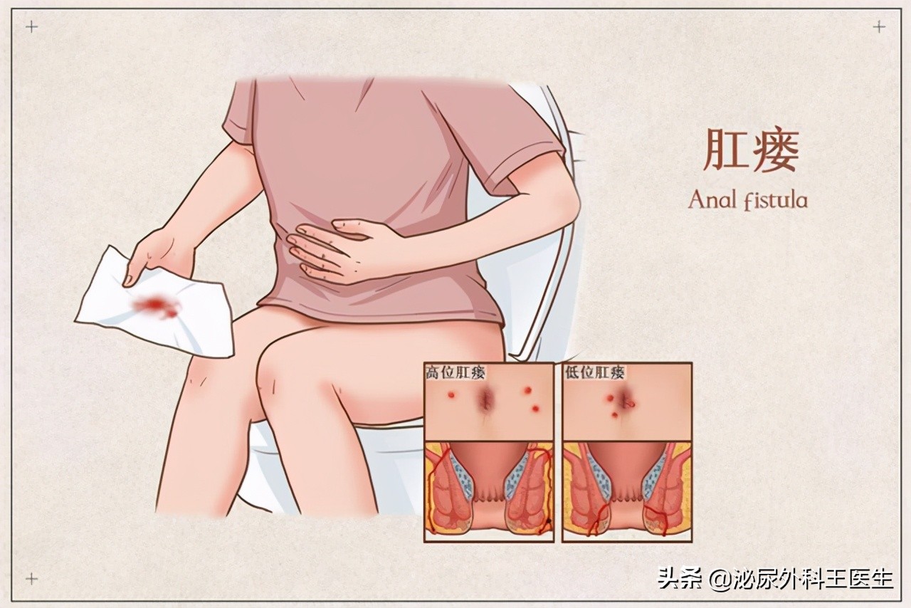 肛瘘引起脓肿不想手术,肛瘘手术好多医院不愿意做咋回事