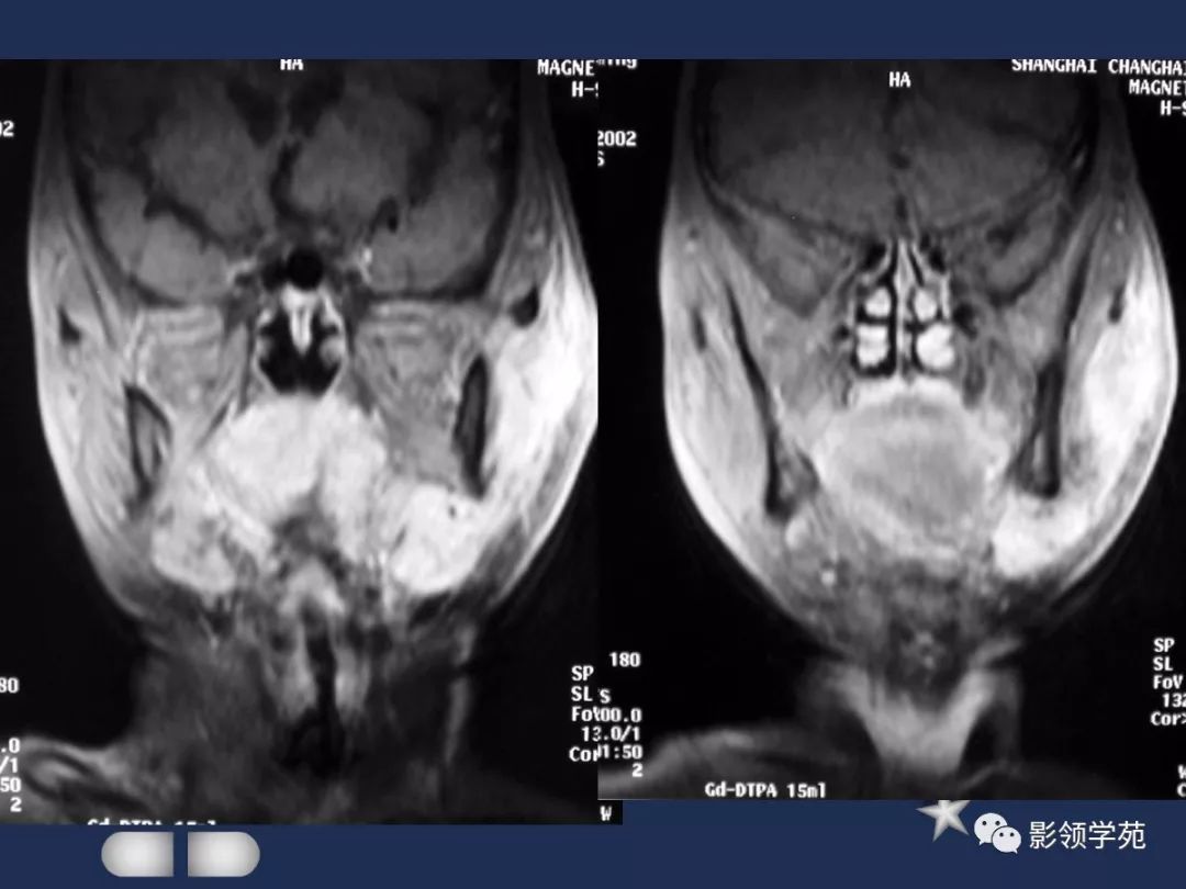 腮腺疾病影像学诊断,腮腺肿块影像诊断