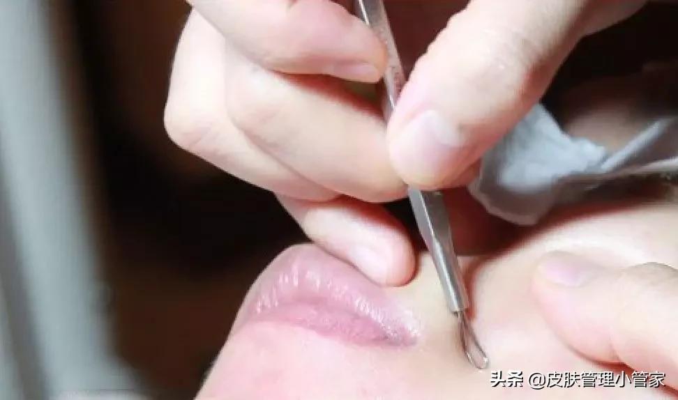 祛斑祛痘皮肤管理,皮肤管理祛痘有效吗