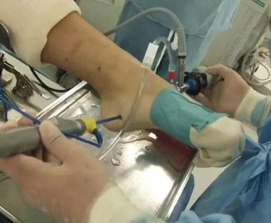 脚跟痛不要再让骨刺背黑锅了,足跟骨刺痛一招教你解决