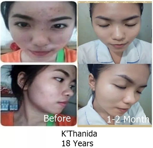 全球公认最好的10款祛痘膏,超好用的一款祛痘膏