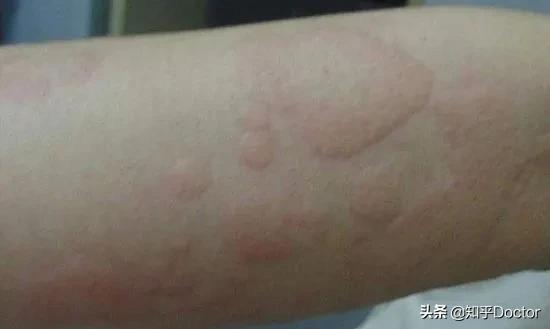 荨麻疹越吃药越重呢,荨麻疹越治越严重怎么办