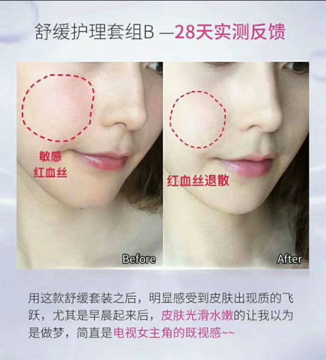 快速缓解痘痘泛红的办法,怎么祛除红血丝敏感痘痘