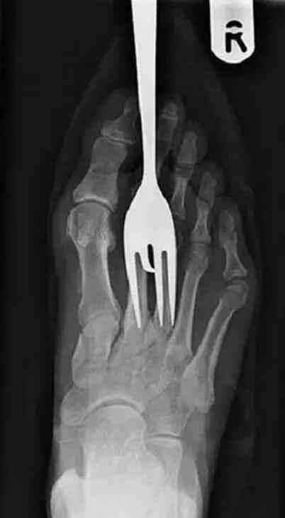 不作死就不会死,看看这些被人类搞进身体里的异物