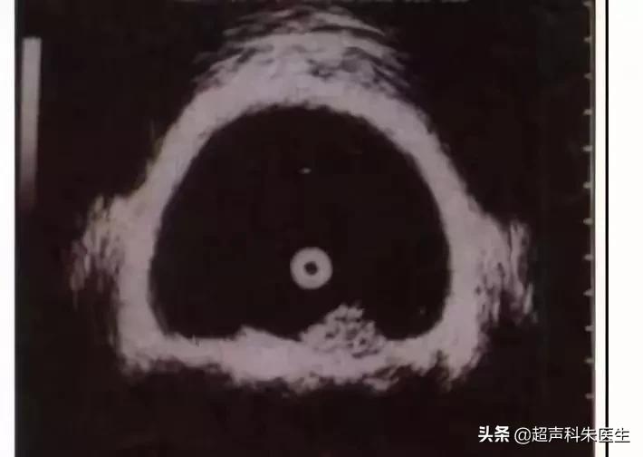 特殊性膀胱炎超声表现,特殊性膀胱炎吃什么药