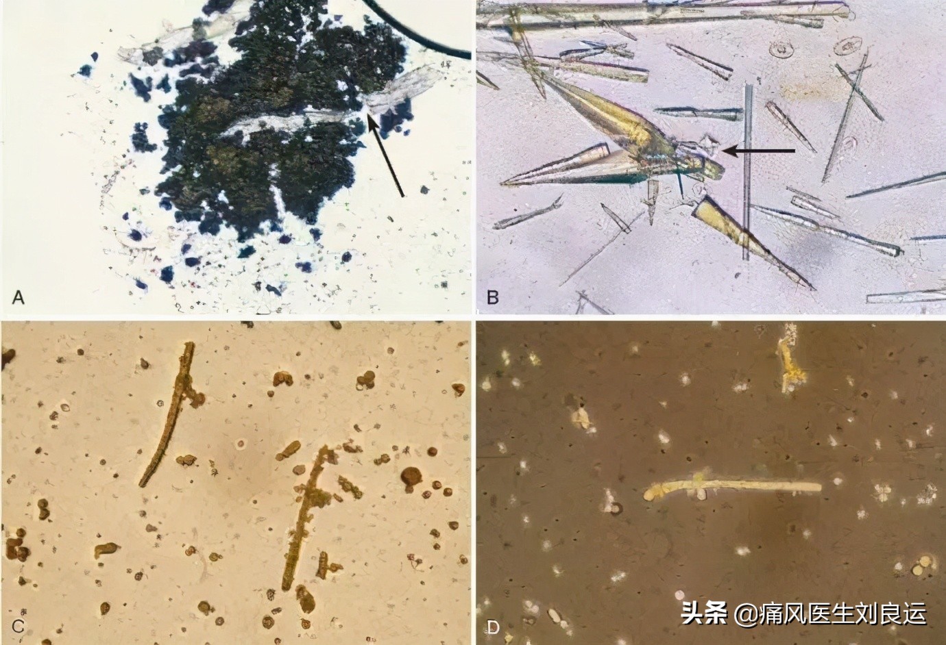 抗生素会引起痛风急性期发作吗,抗生素治风湿吗