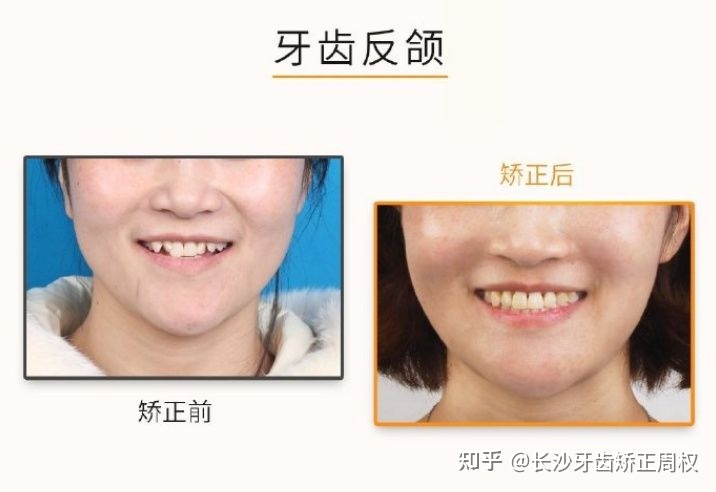 长沙口腔医院反颌矫正,长沙牙齿反颌矫正脸型改变