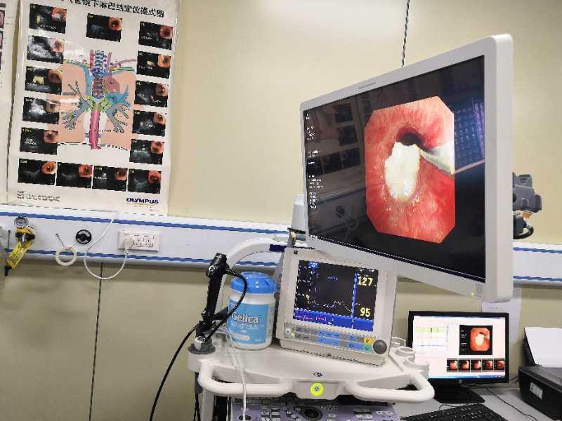 小孩支气管镜取异物技术成熟吗,小儿内镜异物取出术