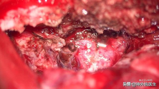 脑膜瘤是什么原因引起的啊,脑膜瘤手术治疗全部大概多少钱