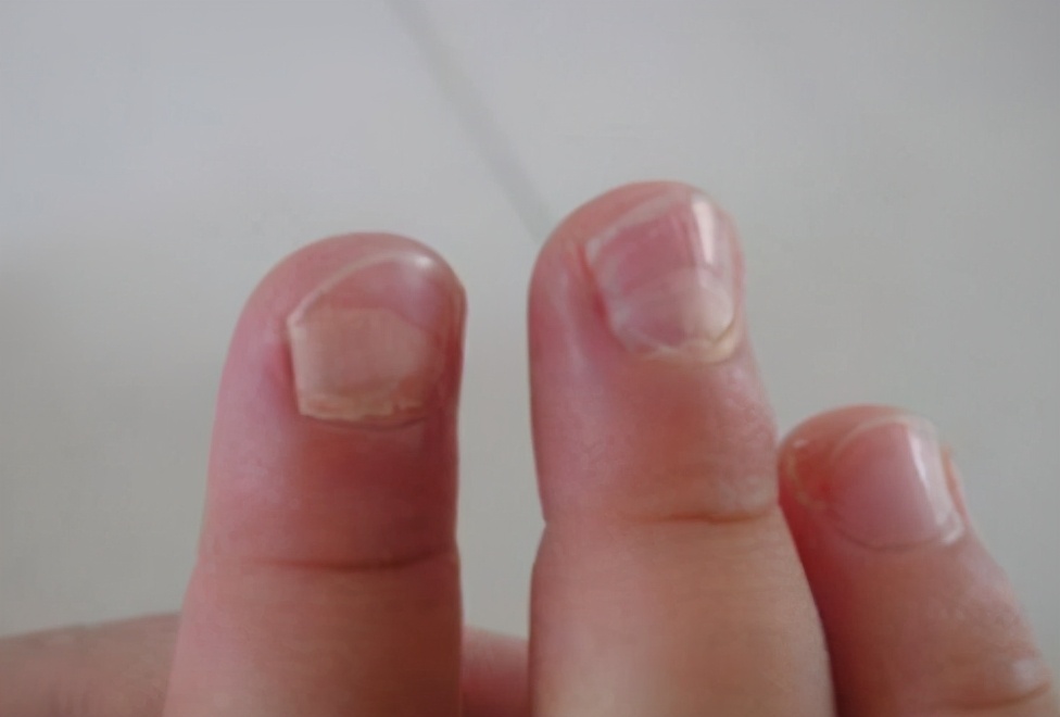 宝宝指甲分层脱落缺什么,宝宝大拇指指甲分层断裂