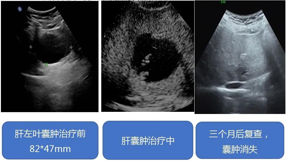 【新技术】红兴隆中心医院超声科|囊肿硬化治疗—针尖上的艺术囊肿患者的福音