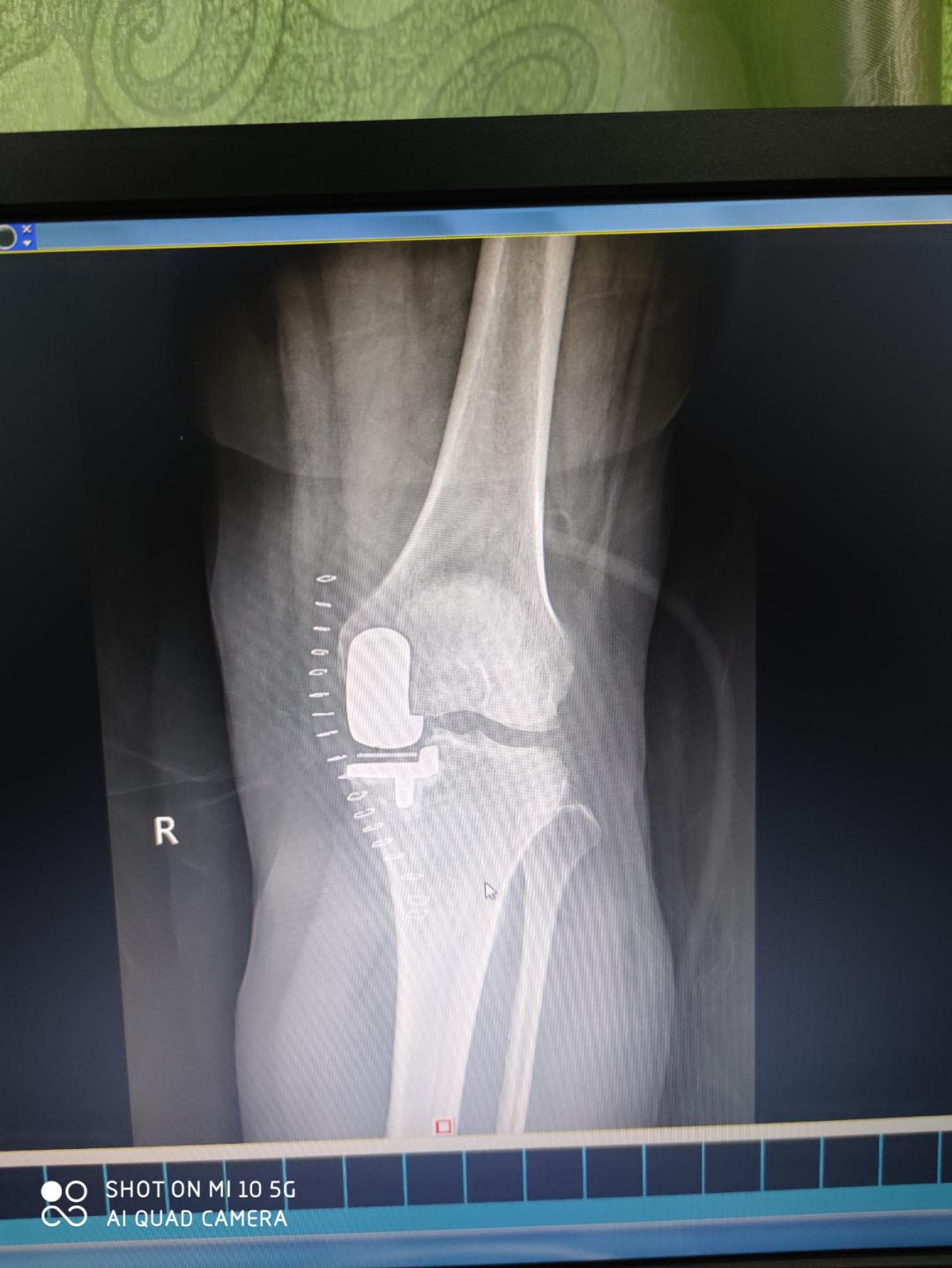 百色市人民医院关节外科开展膝关节单髁置换术,保膝技术再添“法宝”