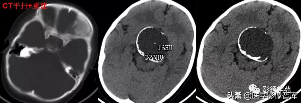鞍区肿瘤做什么检查得出来,鞍区肿瘤的影像学鉴别