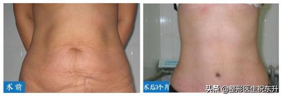 腹部腹壁整形,腹壁整形恢复后腹部图片
