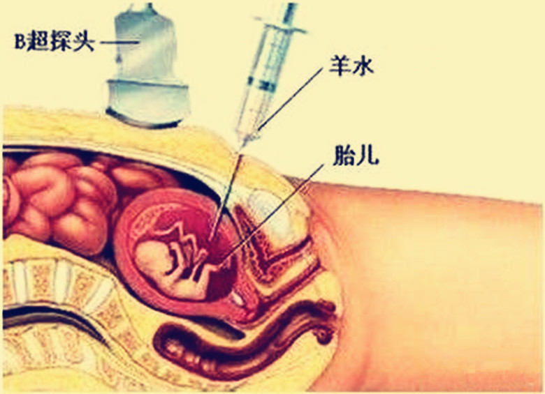 唐筛低风险还有必要羊水穿刺吗,唐筛查出胎儿染色体异常