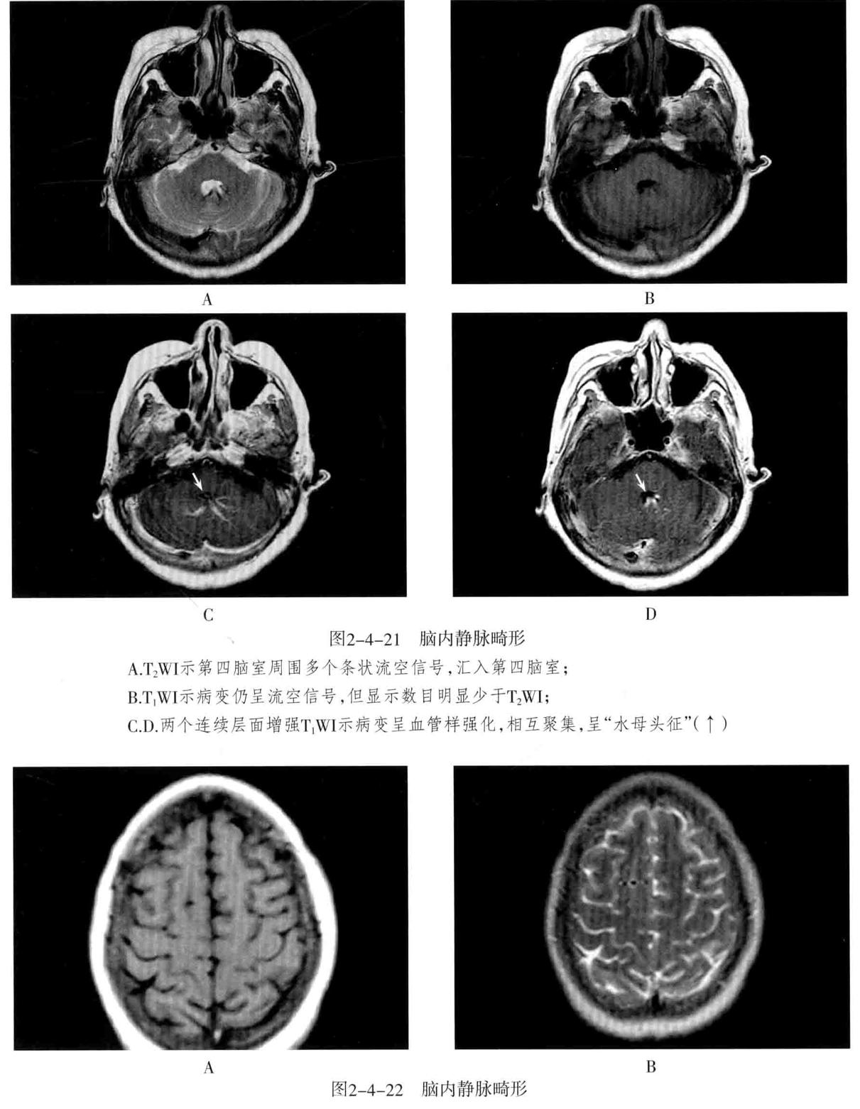 颅内血管轻度狭窄诊断标准,颅内血管先天变异影像