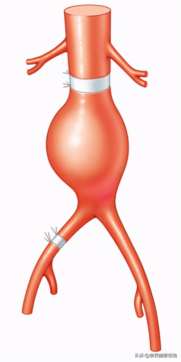 腹主动脉瘤术后内瘘怎么办,腹主动脉瘤出现内瘘解决办法