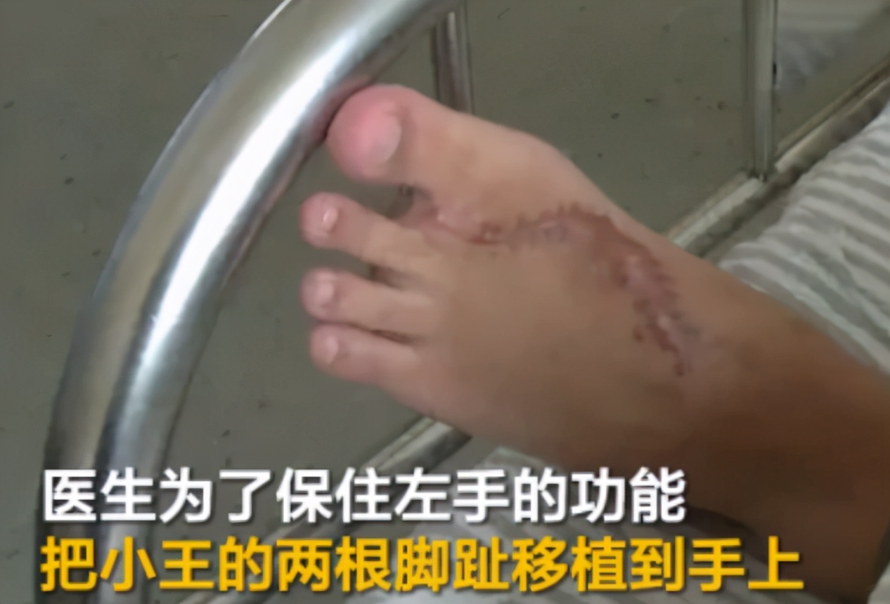 手指没了可以用脚趾代替吗,手指没了可用脚趾接吗