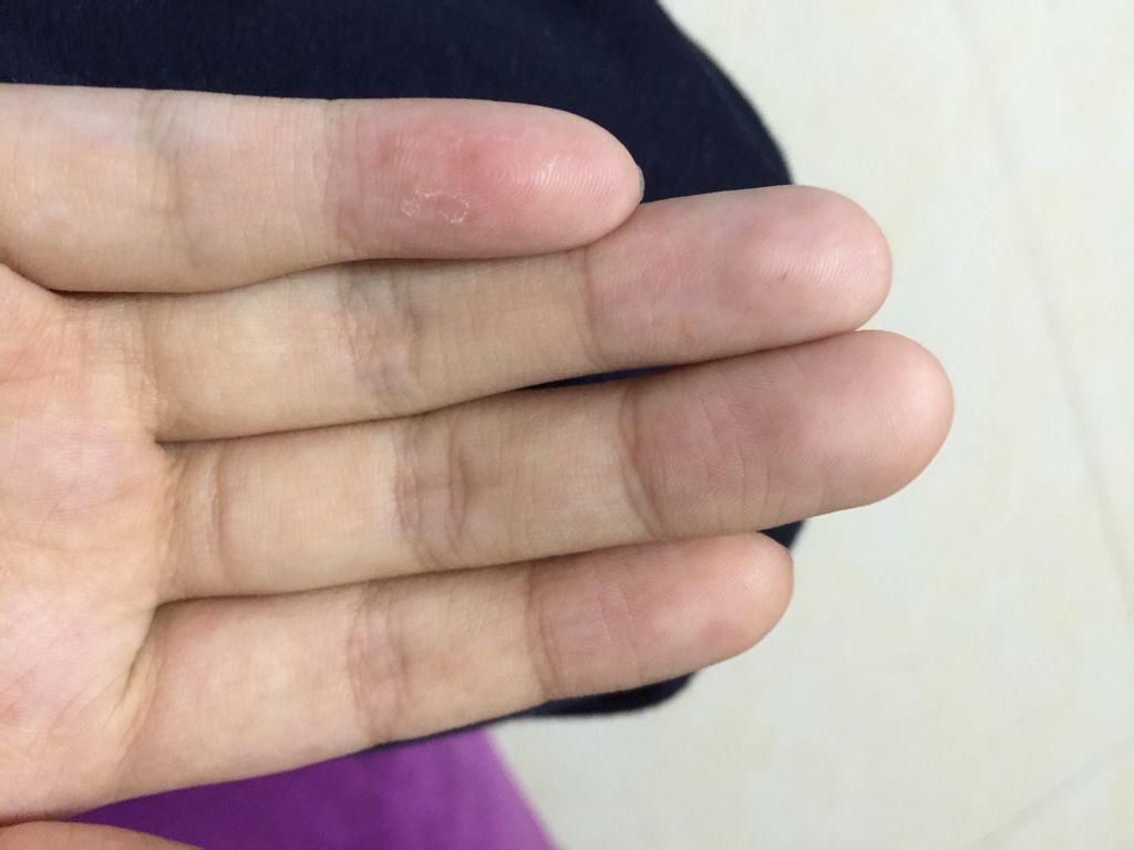 脓性指头炎痒吗,脓性指头炎是橘皮样病变吗