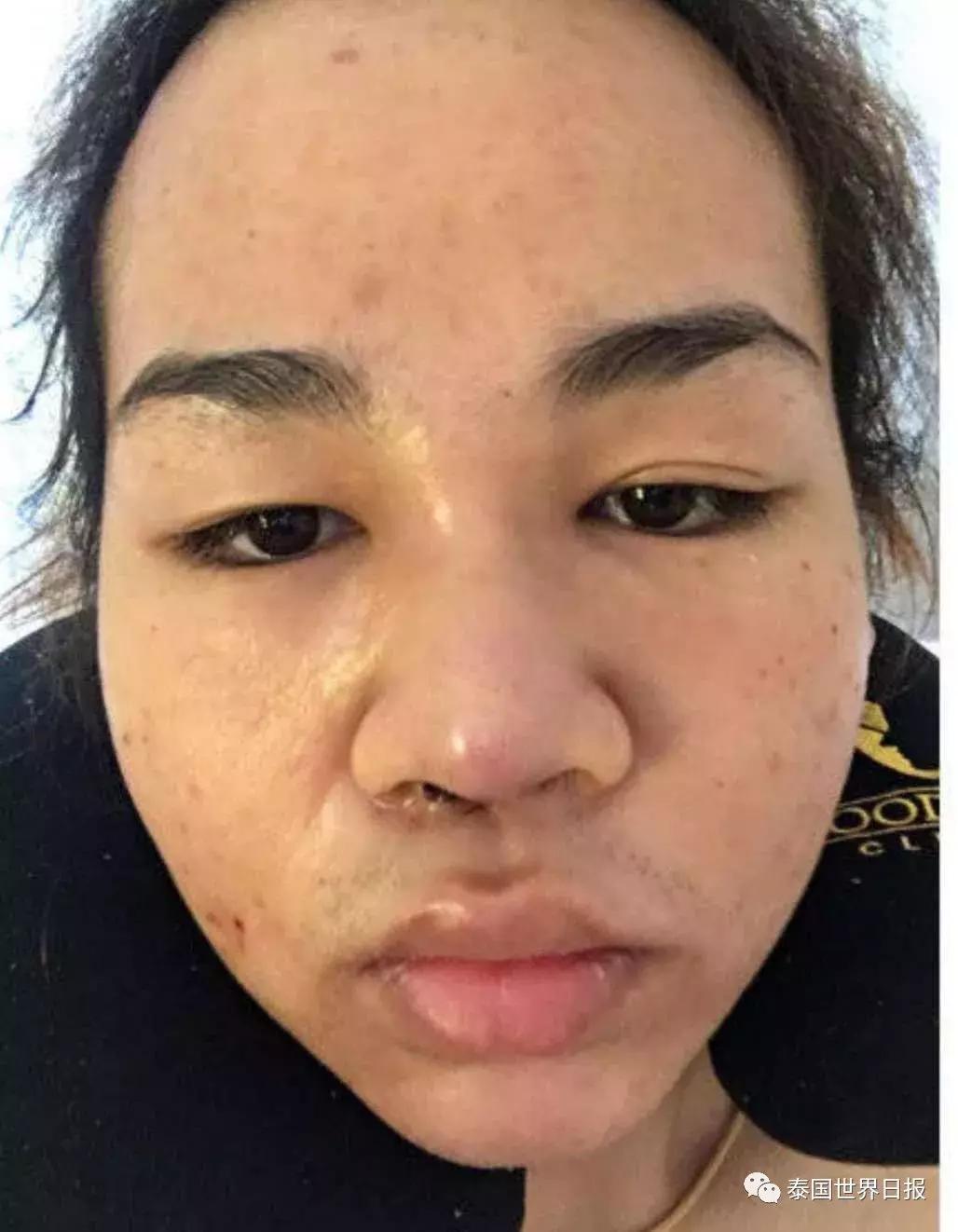 泰国网红Pond妹5年整容史:隆鼻、纹眉、凸魔唇