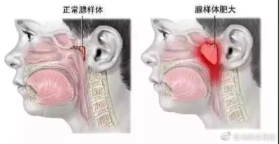 腺样体肥大对长大有什么影响,腺样体长大就萎缩害了多少孩子