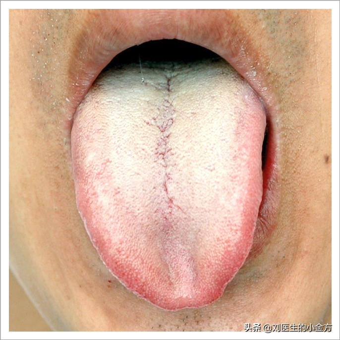 中医舌诊图解100例,中医舌诊图与舌诊口诀