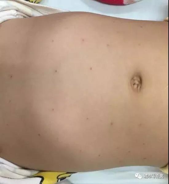 两岁女孩高热后出红疹反复,2岁女孩发高烧24小时