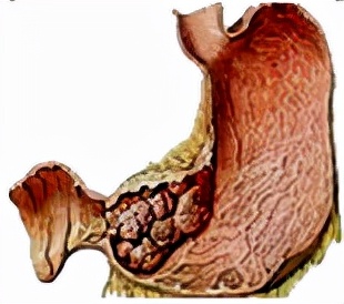 我不是药神,我不是财迷!若患胃癌,这些靶向药你有能力负担吗?