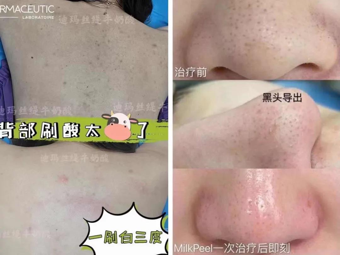 夏天露肉的季节,露肉的正确美白方法